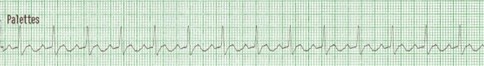 Graphique de la fréquence cardiaque lors d'une activité électrique sans pouls avec QRS étroit