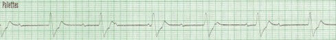 Graphique de la fréquence cardiaque lors d'une activité électrique sans pouls avec QRS large