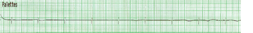 Graphique de la fréquence cardiaque lors d'une asystolie avec présence d'un spicule de stimulateur cardiaque