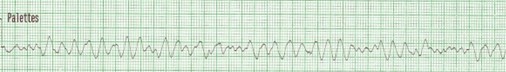 Graphique de la fréquence cardiaque lors d'une fibrillation ventriculaire