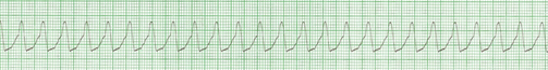 Graphique de la fréquence cardiaque lors d'une tachycardie ventriculaire sans pouls